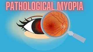 Pathological Myopia  High Myopia  Ophthalmology Lecture [upl. by Storm]