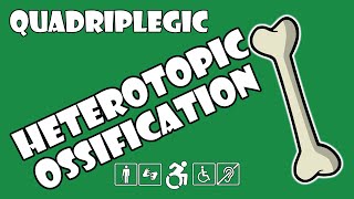 Heterotopic Ossification HO Explained  Quadriplegic C5C6C7 [upl. by Elocan]