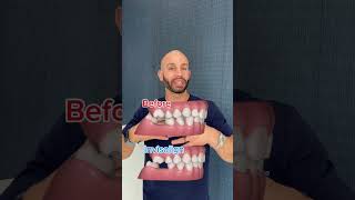 Watch this BEFORE getting dental implants [upl. by Zink]