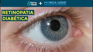 Retinopatia Diabética o que é sinais e sintomas tratamento  Diabetes e Você  Monica Lenzi [upl. by Enyaht]