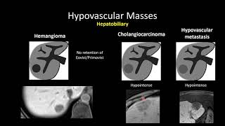 HypoVascular Masses of the Liver [upl. by Lekcar914]