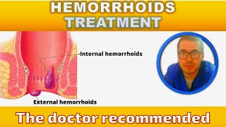 Hemorrhoids treatment [upl. by Yelsnia724]