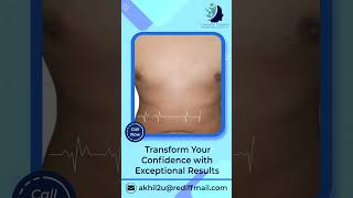 Expert Gynecomastia Surgery by Dr Akhilesh Agarwal  Best Plastic Surgeon in Kolkata [upl. by Hgielram]