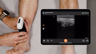 Ultrasound of the Ankle [upl. by Ellesig61]