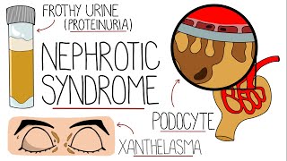 Nephrotic Syndrome Explained Clearly [upl. by Monia545]