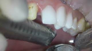 Ceramic crowns removal with the Fotona LightWalker ErYAG dental laser [upl. by Melmon]