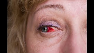 Subconjunctival Hemorrhage  Causes Signs amp Symptoms Treatment [upl. by Dietsche48]