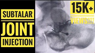 Fluoroscopic Subtalar Joint Injection [upl. by Rame66]