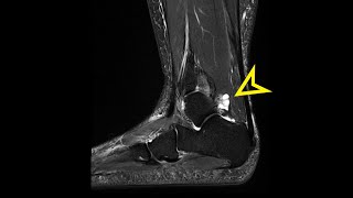 Ankle MRI Ganglion Cyst [upl. by Meuser]