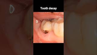 Filling tooth decay process dentistry dentist filling tooth [upl. by Kokoruda]