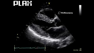 Parasternal Long Axis View PLAX [upl. by Atronna]