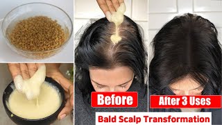 Apply👆🏼Methi Like This on Bald ScalpGet Thick Fuller Hair Growth in 3 UseBald Scalp Transformation [upl. by Seitz]