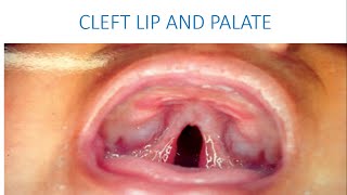 CLEFT LIP AND PALATE  DEVELOPMENTAL DISTURBANCES OF THE JAW [upl. by Siegfried759]