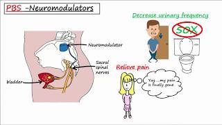 Painful Bladder Syndrome PBS  Interstitial Cystitis IC [upl. by Kenn]