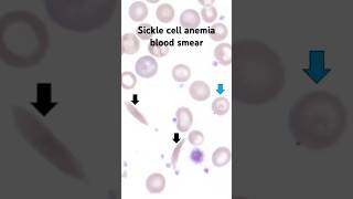 Sickle cell anemia under microscope Blood smear hematology Hematopathology worldsicklecellday [upl. by Airekat]