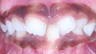 Mixed dentition braces in 10 year old boy mybracesdentalclinic3511 [upl. by Catharine]