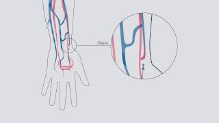 Understanding hemodialysis [upl. by Ardnaek]