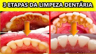 Limpeza Dentária Como Funciona e quais etapas resumo [upl. by Luckett]