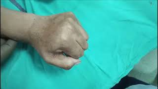 Postburn contracture of left hand [upl. by Bej]