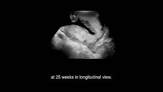 Placental Abnormalities vasa previa morbidly adherent placenta placental abruption [upl. by Pejsach]