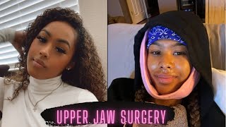 Story time Upper Jaw Surgery Experience [upl. by Godden782]