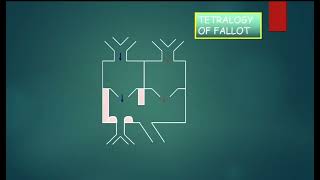 CCHD 2 Tetralogy of Fallot Prof Wael Attia [upl. by Yesnikcm972]