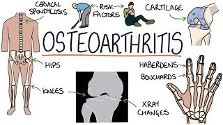 Understanding Osteoarthritis [upl. by Ayatnahs]