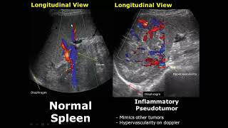 Spleen Ultrasound Normal Vs Abnormal Image Appearances Comparison  Splenic Pathologies On USG [upl. by Attenweiler651]