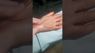 Scleroderma  Hard sclerotic skin  Sclerodactyly [upl. by Fricke]