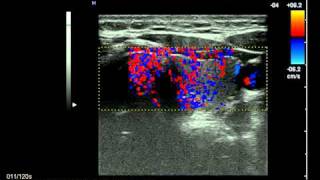 ecografiatiroidenormaleendocrinologiaoggiavi [upl. by Anolahs]