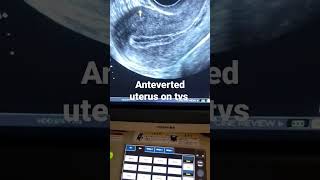 what is Anteverted uterus and how its looks on tvs ultrasound [upl. by Kyla465]