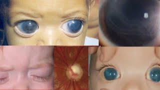 PRIMARY CONGENITAL GLAUCOMA  buphthalmos megalocornea haabs striae cupping and more [upl. by Anikal]