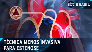 SUS oferece técnica menos invasiva para o tratamento de estenose aórtica  SBT Brasil 170424 [upl. by Ymassej]