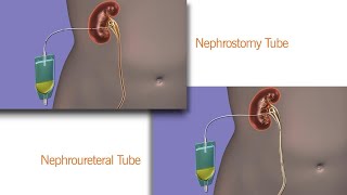 Your Nephrostomy or Nephroureteral Drain [upl. by Russ]