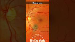 Choroidal nevus [upl. by Araht]