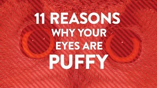 11 Reasons Why Your Eyes Are Puffy  Health [upl. by Brigit]