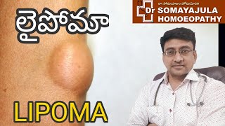 LIPOMA Homeopathic Treatment  Telugu  Dr Suresh Somayajula [upl. by Ferren529]