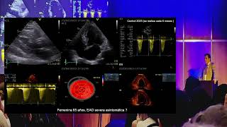 Estenosis Aortica Asintomatica Cuando pienso en Intervenir [upl. by Nic458]