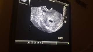 Pregnancy ultrasound 5 weeks and 5 days [upl. by Amy566]