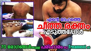 500 രൂപ മുടക്കിൽ കൊഴുപ് വെരികോസ് hair problem എന്നിവക്ക് Treatment Hijama malayalam kerala [upl. by Yuille]