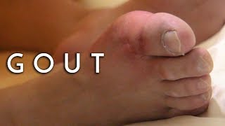 Relief from Gout Pain  Principal Podiatrist Michael Lai East Coast Podiatry [upl. by Cila]