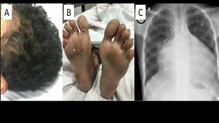 ARVD OR ARVD OR NAXOS SYNDROME 4TH YR [upl. by Chernow]