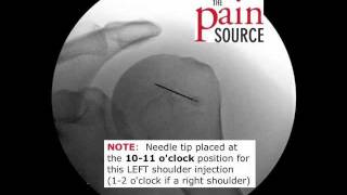 Glenohumeral Shoulder Injection under Fluoroscopic Guidance  ThePainSourcecom [upl. by Trebliw92]