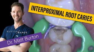 Dr Matt Burton When to Use BurtonBands Interproximal Root Caries Scenario [upl. by Mannos346]