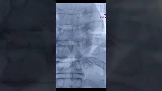 IABP Intraaortic Balloon placement with markers and sizing [upl. by Robinson793]