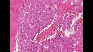 Histopathology OvaryGranulosa cell tumor [upl. by Farrell]