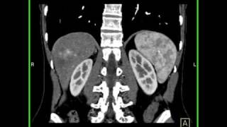 Abdomen Liver Cavernous Hemangioma of the Liver2 of 9 [upl. by Kenric147]