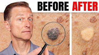 How to Remove Skin Tags and Warts Overnight  Dr Berg Explains [upl. by Damalus]