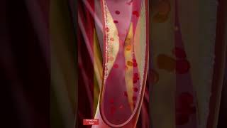 Angioplasty l Coronary artery Stenting l Animation heartattack shorts [upl. by Eedyak869]