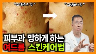 집에서 여드름 없애는 방법 자가관리로 여드름 없애는법 여드름 닥터가 알려드립니다 [upl. by Nancie]